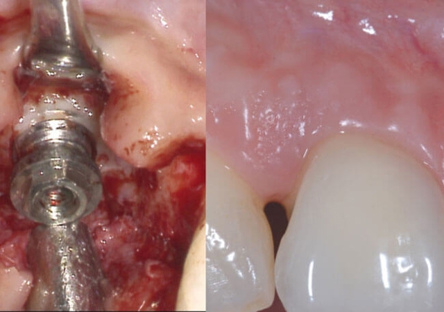 regeneration-implant-oral-surgeon-dentist