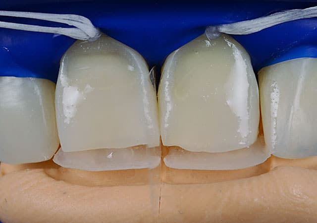 restorative dentistry case pascal magne