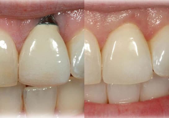 implant dentistry treatment