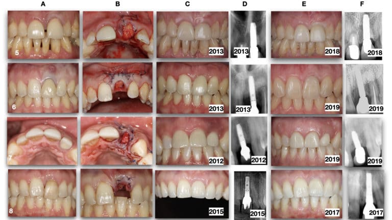 bone augmentation in dentistry