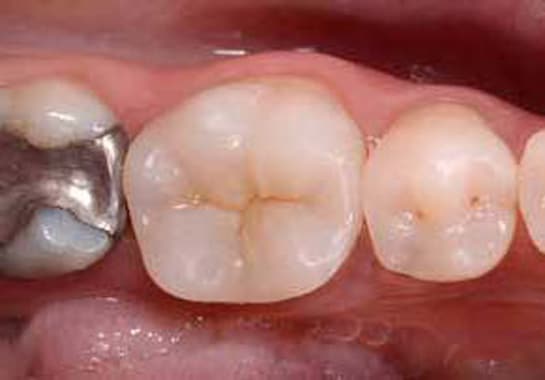 esthetic posterior restorations course