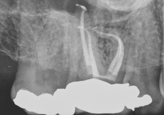 mini residency in endodontics