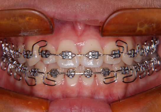 occlusion-orthodontics